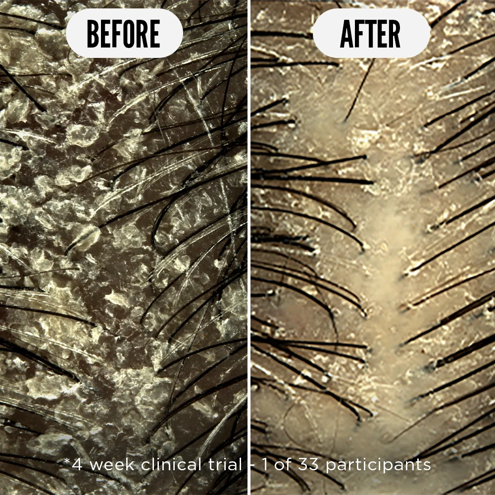 Sensitive Scalp Starter Bundle - Image 4